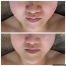 시흥 목감 피부관리 더미샵 에스테틱 황비골근윤곽(테라노바+R4U+DPL3000샷)