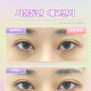 서울고려의원 | 서울동안의원 애교필러 후기｜중안부 짧아보이는 동안 얼굴 만들기