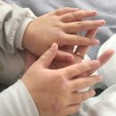 동전 | 우리 딸 아이 아토피 동전습진 극복 후기