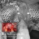 금천근본튼튼의원 | 금천구임플란트 식립 위치와 깊이 그리고 간격