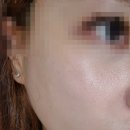 200 | 강남 신논현역 피부과 울트라콜200 후기