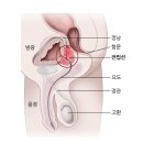전립선절제술 이미지