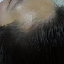 에이원헤어라인 이미지