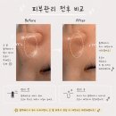 전주 슈퍼젝션 전문, 담솔스킨 방문 후기