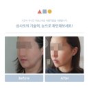 삼사오 - 서구 월드컵4강로198번길 19-4 | 신논현 최소절개스마스리프팅 후기 | 삼사오성형외과
