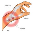 신근열 | 드퀘르뱅 건초염 시도한 방법