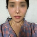 인디언리프 | 홍대피부과 실리프팅 후기｜팔자주름 원더트리플 실리프팅 후기
