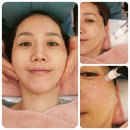218-2-000025 | 원흥피부관리 원흥에스테틱 원흥피부샵 4W에스테틱 MTS 스킨젝션 강추