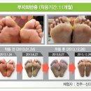 손태석 발가락운동용구 이미지