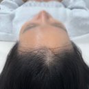 솔비헤어라인 | 전주 헤어라인문신 후기 -두피문신전문점 두온뷰티