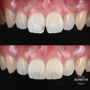 대동치과재료상사 | V로 벌어진 앞니 레진 치료로 하루 만에 해결하기 / 내 치아같이 자연스러운 앞니 빌드업 레진치료 후기