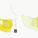 돌출입 : 양악전돌증 - 돌출입 수술 필요성과 치료 과정 이미지