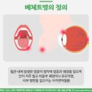 베체트병 증상 구강궤염 구강염 자가면역질환 초기신호 이미지