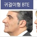 청음보청기 이미지