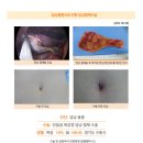 담낭용종수술후기. 타 병원에서 건강검진 이후 담낭에 용종이 적지 않은 크기로 발견해서 마음이 안 좋았었는데... 이미지