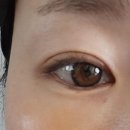 장스속눈썹 | 대구 성형외과 눈밑지방재배치(+장스니들) 수술 후기