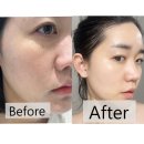 볼륨 | 광명피부과 리쥬란+쥬베룩볼륨 후기(feat.자연스럽게 달라진 얼굴 컨디션)