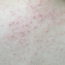 210103 | 210103 성인 아토피로 고생한 후기 / 고대구로병원 처음 방문이라면?