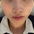 좁쌀여드름 고민 해결✨ 청담피부관 리무드 에스테틱 콜드플라즈마 시술 후기