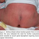 씨제이(C.J)홈마트 | [신생아 딤플] 아기 엉덩이 보조개, 괜찮을까요? (단순 vs 고위험 구별법, 의학 논문)