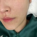 사가정피부관리 브로우니옥 고주파 효과 있을까?