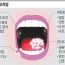 ■12월20일 목요일■입술 물집은 전염 가능.. 그물 모양 염증은 조직검사 받아야 이미지