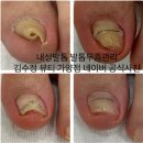 가양역 7번출구 | 가양역발톱관리 김수정 뷰티 가양점 내성발톱 뽑은 후기