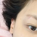 비앤비한의원 | 홍대흉터치료 여드름한의원 새살침 율각테라피 후기 2-3회 차