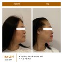 이진쵸이스