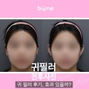 제니성형외과의원 | 귀 필러 후기, 효과 있을까? 카리나, 제니처럼 작은 얼굴 만드는 비밀 (가격, 통증, 전후 비교)