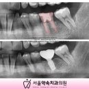 골드 크라운 탈락으로 청주 금천동 치과 발치 후 즉시 식립 임플란트 수술 후기