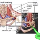 흉곽출구증후군(Thoracic outlet syndrome) 이미지