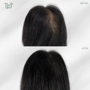 TMW 탈모왕수원 이미지