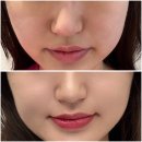 디지털스킨 | 구로디지털단지피부과 &lt;스킨부스터 포텐자&gt; :: 예신관리, 2회차 내돈내산 솔직후기