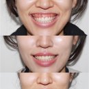 엘투치과의원 | 거미스마일 보톡스 : 웃을 때 잇몸 많이 보이는 경우 간단하게