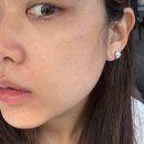 달 | 목동피부과 레이저리프팅 한달 후기