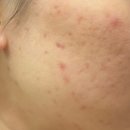 한티역약국 | 한티역 함익병 피부과(4회차까지 후기/종로 약 구매)