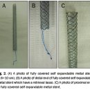 완전 피막형 자가팽창성 금속 스텐트를 이용한 양성담관협착의 치료 이미지