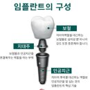 베트남 임플란트 이미지