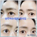 송탄드림약국 | 평택 송탄 속눈썹펌 원네일, 절개쌍수5개월차