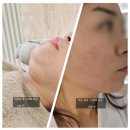 호텔오비탈 | 내돈내산] 40대피부리프팅추천시술 ,연예인도 받는리프팅시술 튠페이스 + 페리오비탈 고주파레이저 후기