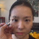 [압구정: 재돈 성형외과] 쌍수 상담 후기, 가격, 붓기, 유튜버 ㅅㅇ님 쌍수 병원