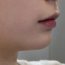 라임 | [청담피부과] 울쎄라 피프라임 내돈내산 후기 얼굴선 솔직 변화 기록