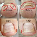 세븐일레븐 의정부가능행복점 | 의정부 네일샵 '네일온 레푸스 가능점' 내성발톱 관리 내돈내산 후기.2