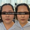 리스칼프