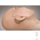 안면거상 수술 어떻게 하는지 알아? 이미지
