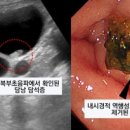 [100세건강] 명치 심하게 아프다면 담석증 의심…식습관 개선해야 이미지