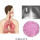 폐렴 관리 폐렴예방주사 마이코 플라즈마 폐렴 증상 이미지