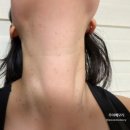 성지요양병원 | 서울 피부과 편평사마귀 성지 무제한 얼굴 목 제거 가격 내돈내산