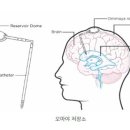 뇌 전이암 환자의 치료, 오마야 수술이란 무엇인가 이미지